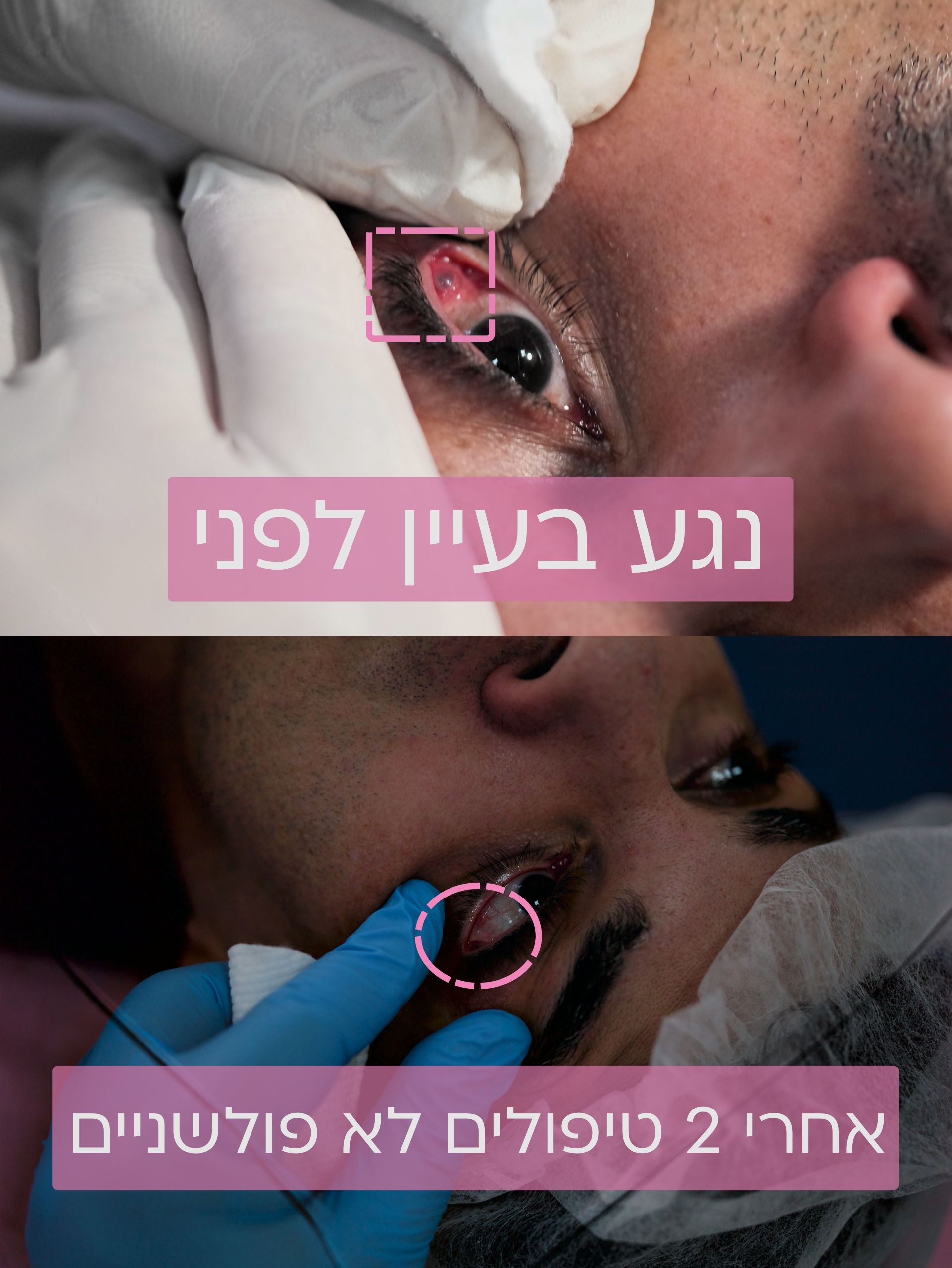 הבהרת כהויות מתחת לעפעף התחתון | טיפול בצבע כחול מתחת לעיניים 4 העלמת נגע בתוך העיין ללא סכין