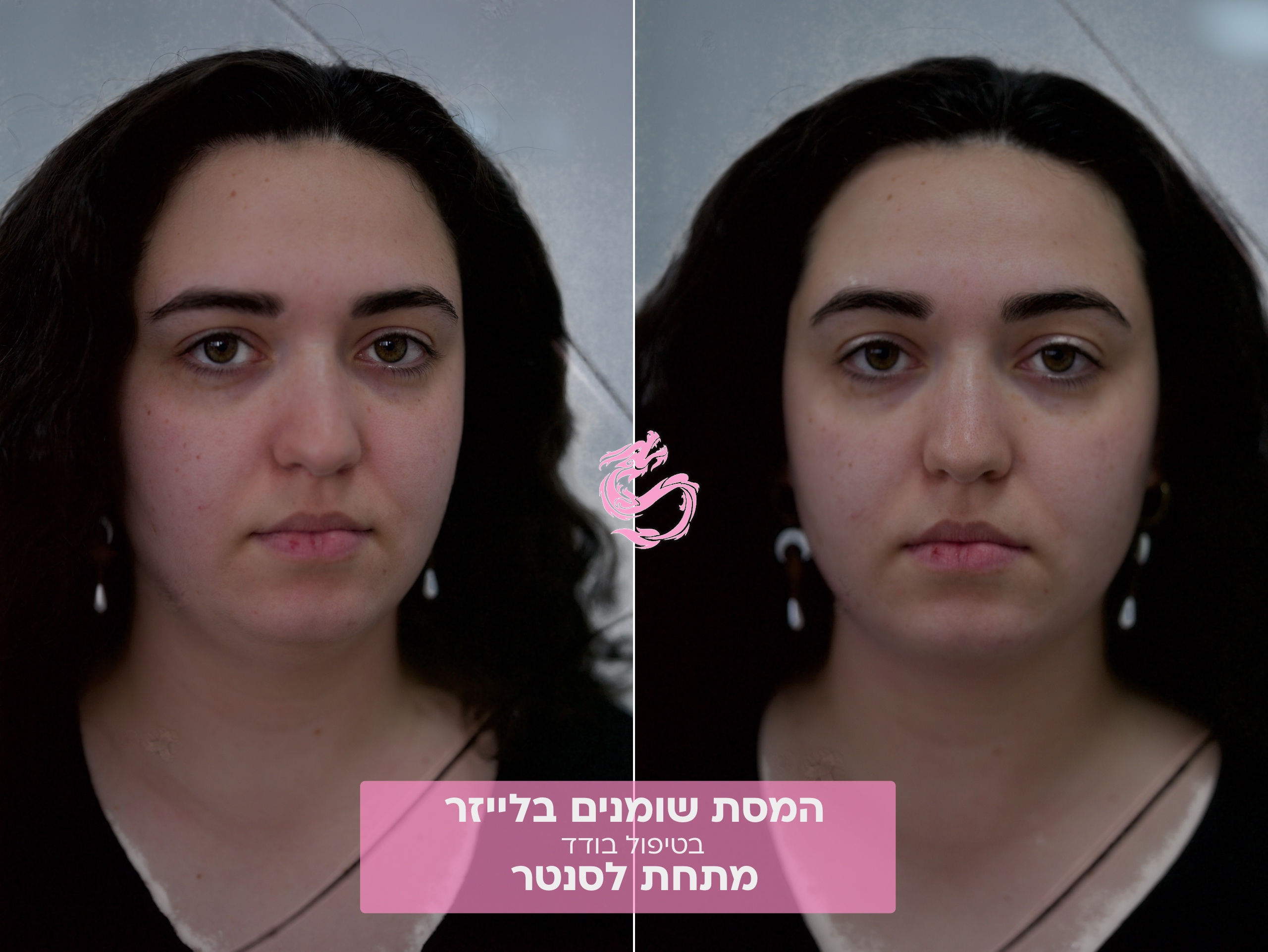 סנטר כפול מתיחה בקוו לסת בלייזר 2 העלמת סנטר כפול נרקיסיה