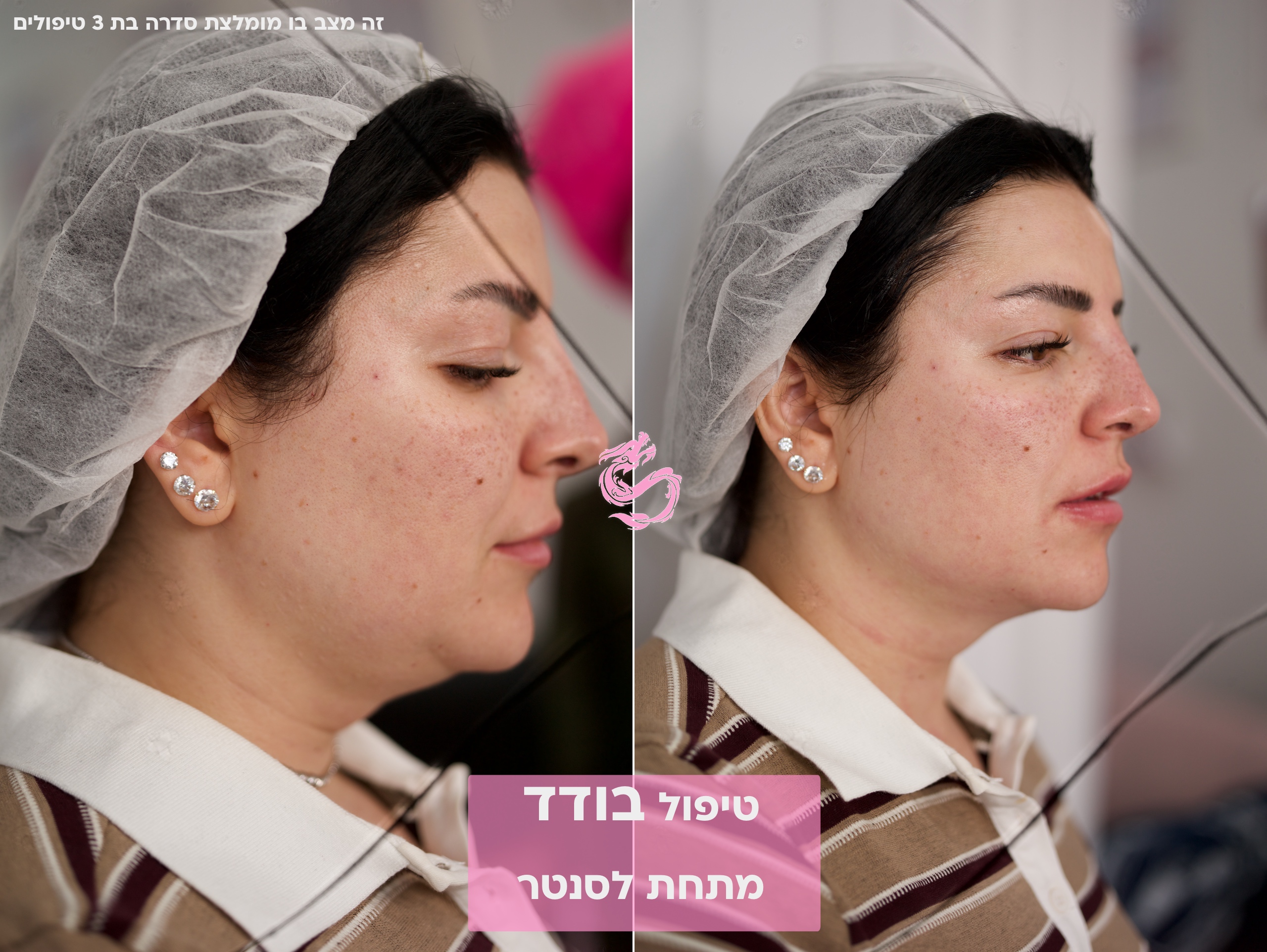 סנטר כפול מתיחה בקוו לסת בלייזר 4 סנטר כפול