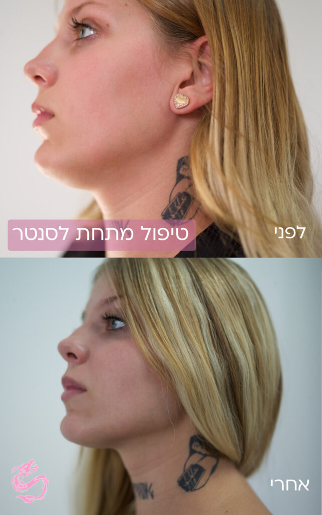 סנטר כפול מתיחה בקוו לסת בלייזר 1 טייסיה גרצ׳קיס