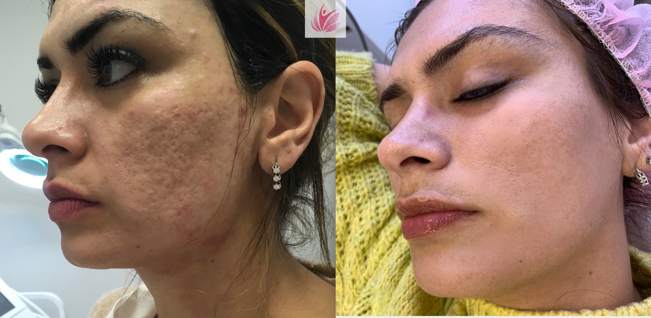נקבוביות עמוקות | פצעי אקנה | צלקות אקנה | PostAcne | לדוגמאות היכנסו 6 טיפול בצלקות אקנה