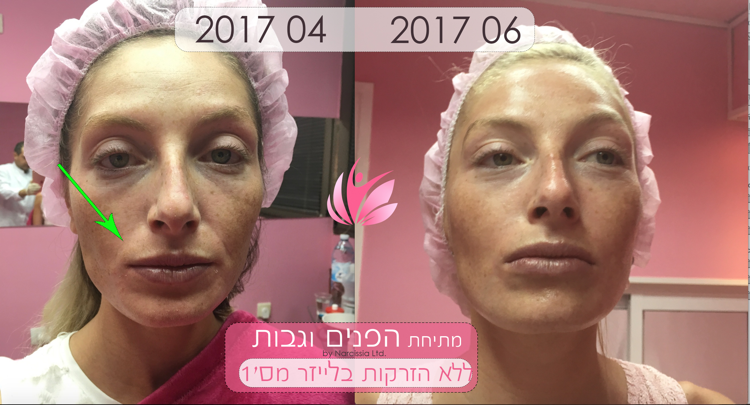 Акция - UpLift - процедура моментальной подтяжки лица 3 טיפול 5D לצעירים
