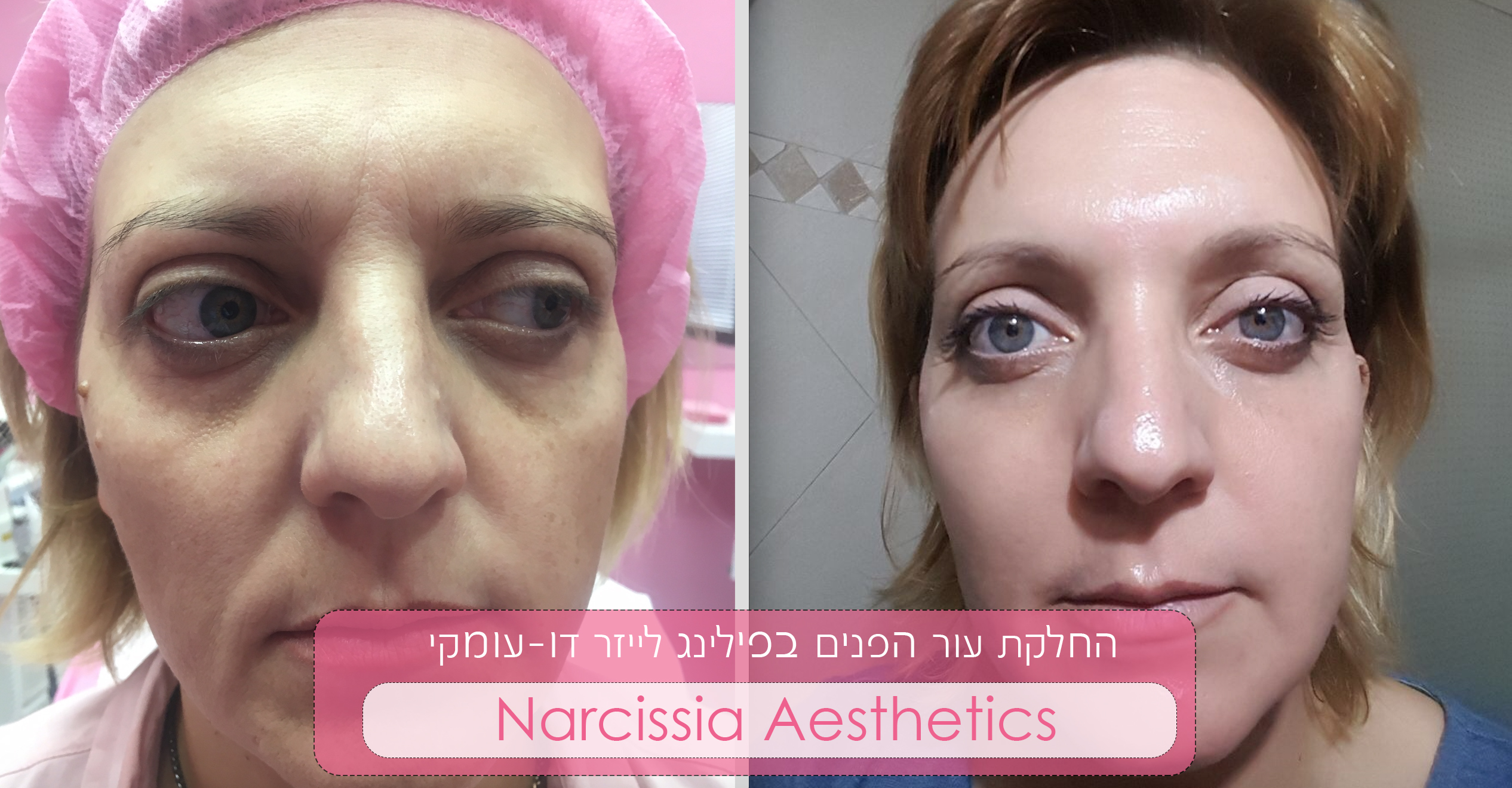 טיפול פנים Fotona4D® 3 הצערת פנים בנרקיסיה
