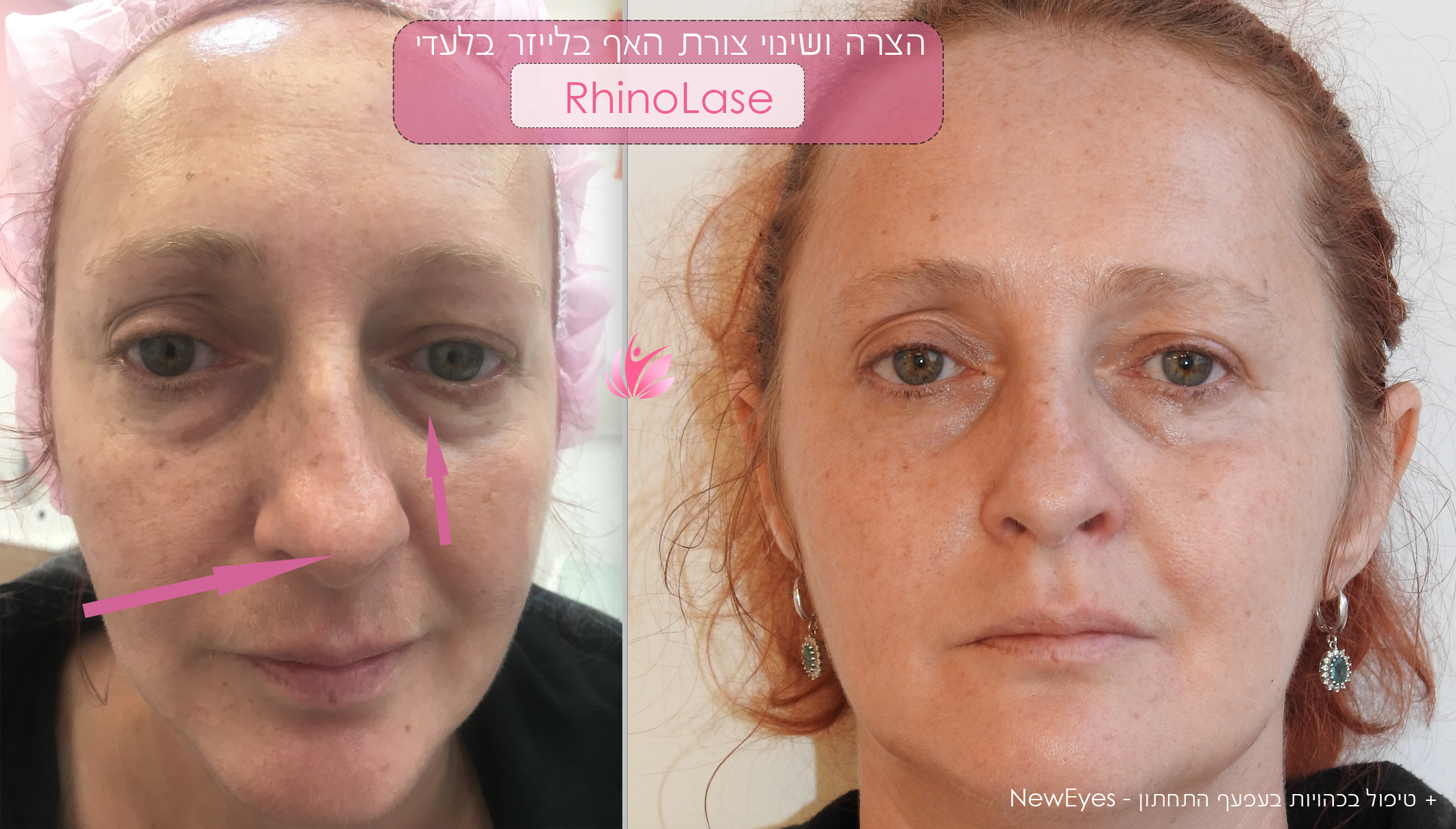 Nose change without surgery