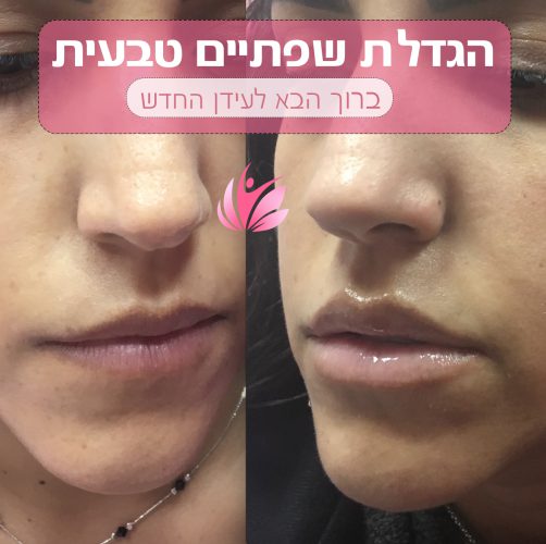 הגדלת שפתיים בלייזר