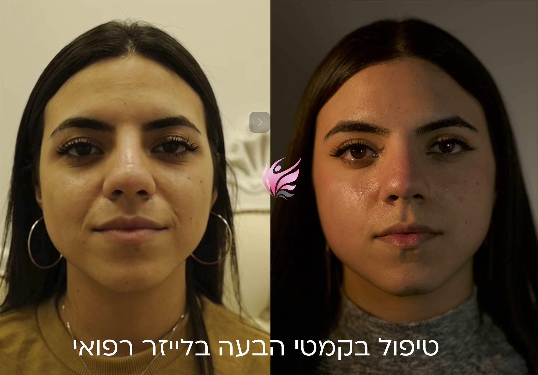 Акция - UpLift - процедура моментальной подтяжки лица 1 טיפול בקמטי הבעה ליד הפה בלייזר וללא מילוי הזרקות