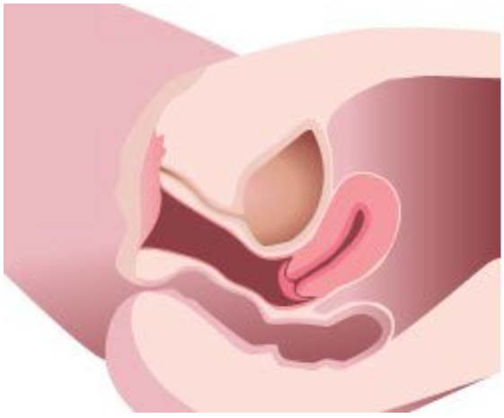דליפת שתן | טיפול בלייזר שפותר בעיה 4 SUI non invasive treatment