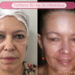 משוואה מנצחת לפנים צעירות 5D Light 14 dralberto