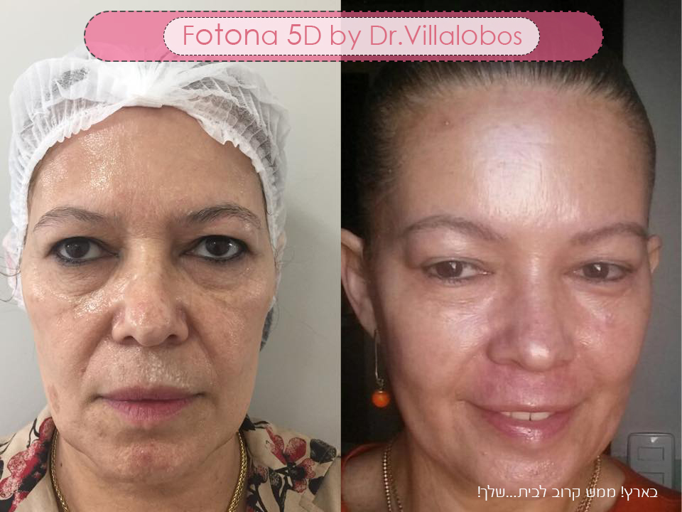 Fotona Face Rejuvination 1 fotona 5d