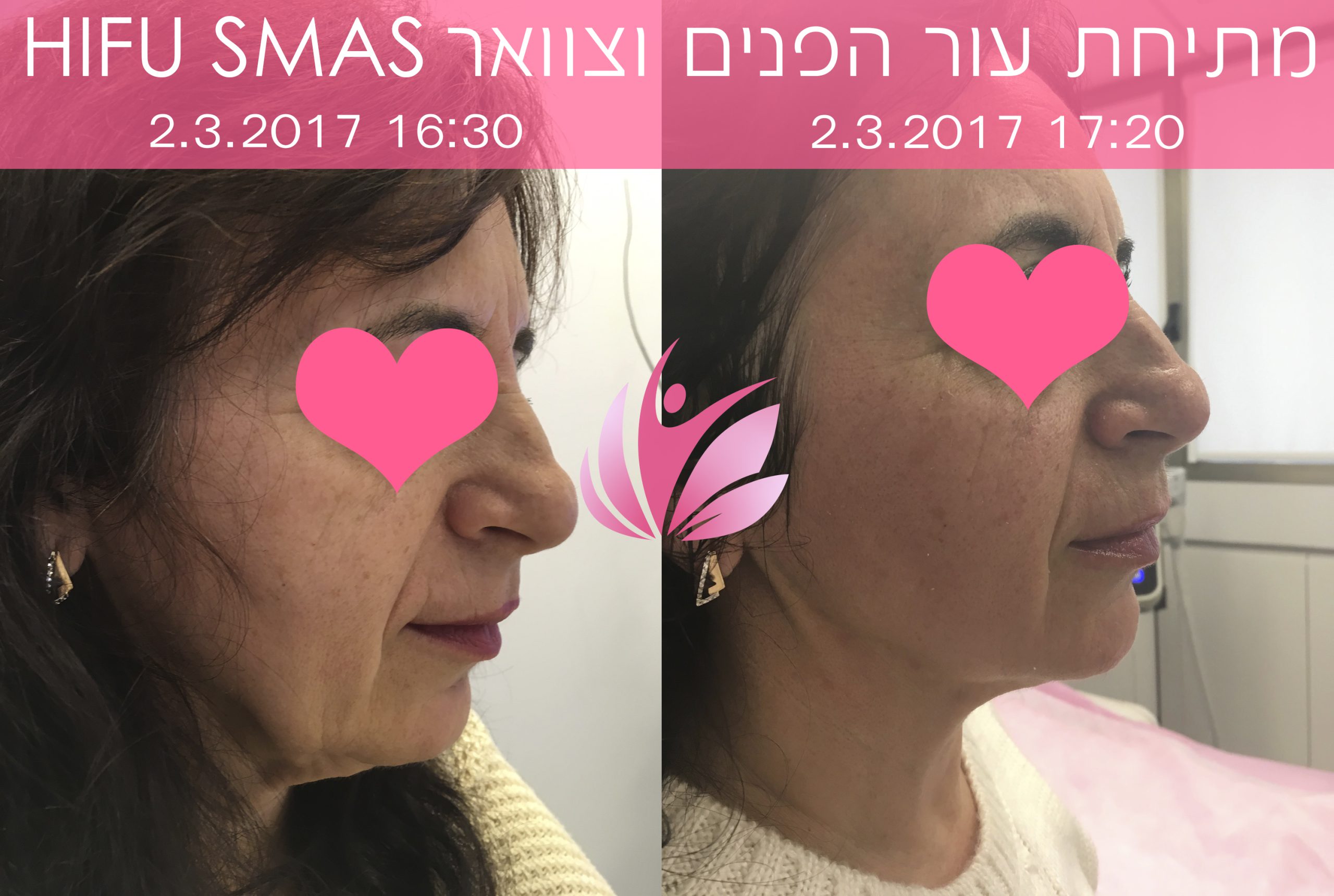 подтяжка лица
