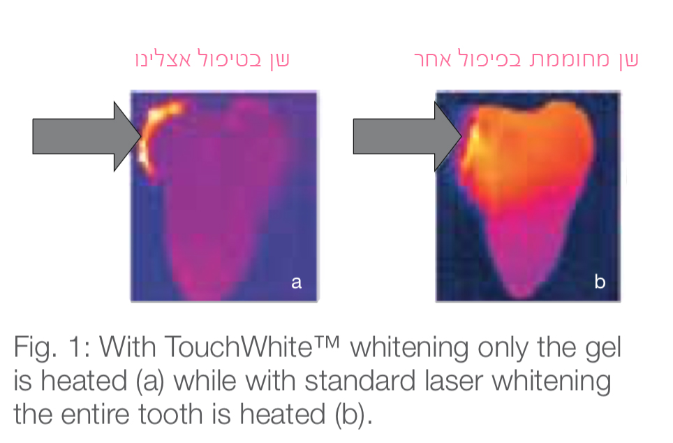 הלבנת שיניים בלייזר 2 touchwhite