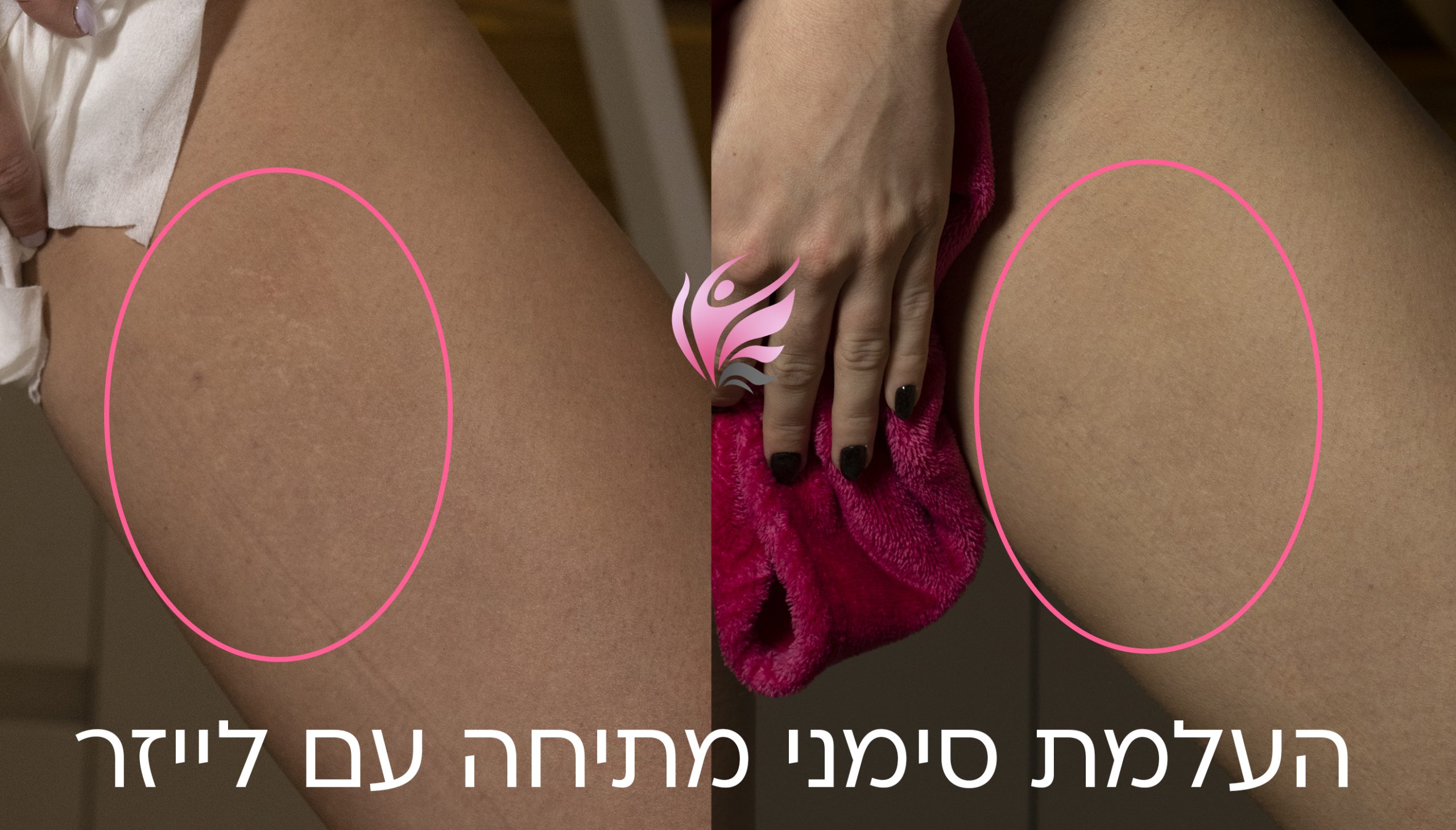 מחוך נצחי בדמות הטיפול להעלמת סימני מתיחה 2 טשטוש סימני מתיחה עם לייזר רפואי