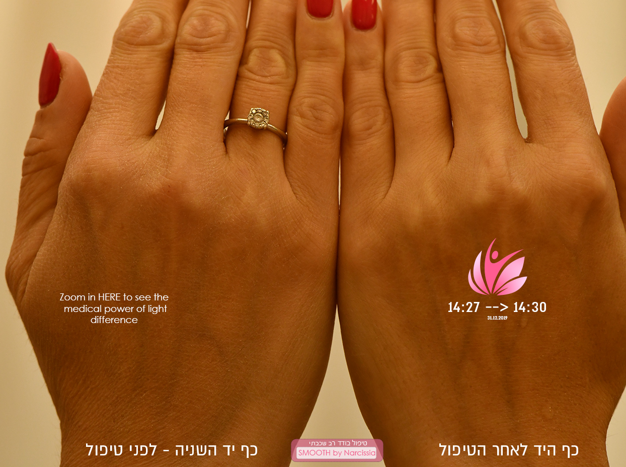הצערת מראה כפות הידיים בלייזר 1 מיצוק עור הידיים
