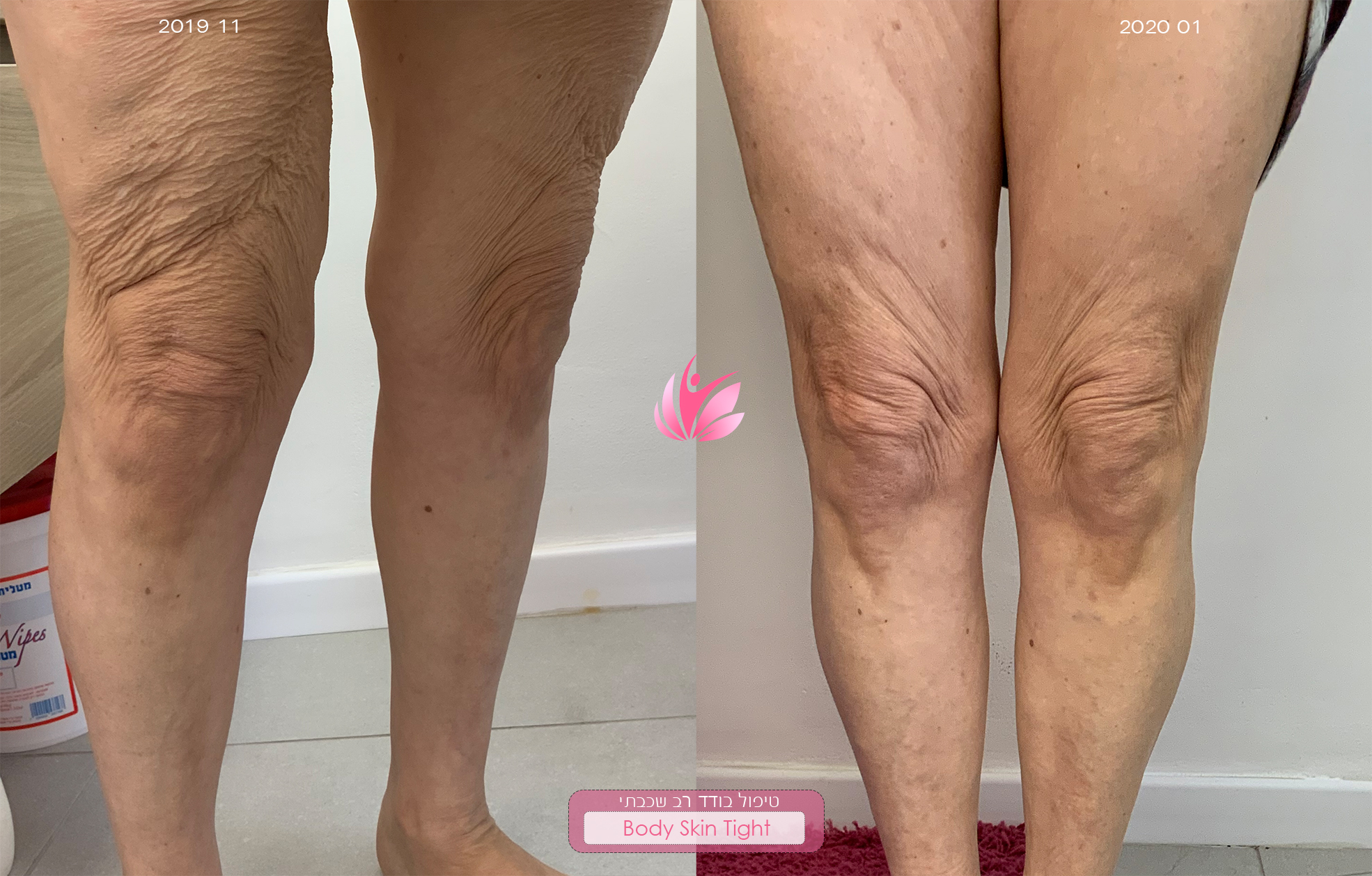 מחוך נצחי בדמות הטיפול להעלמת סימני מתיחה 4 Skin body rejuvenation