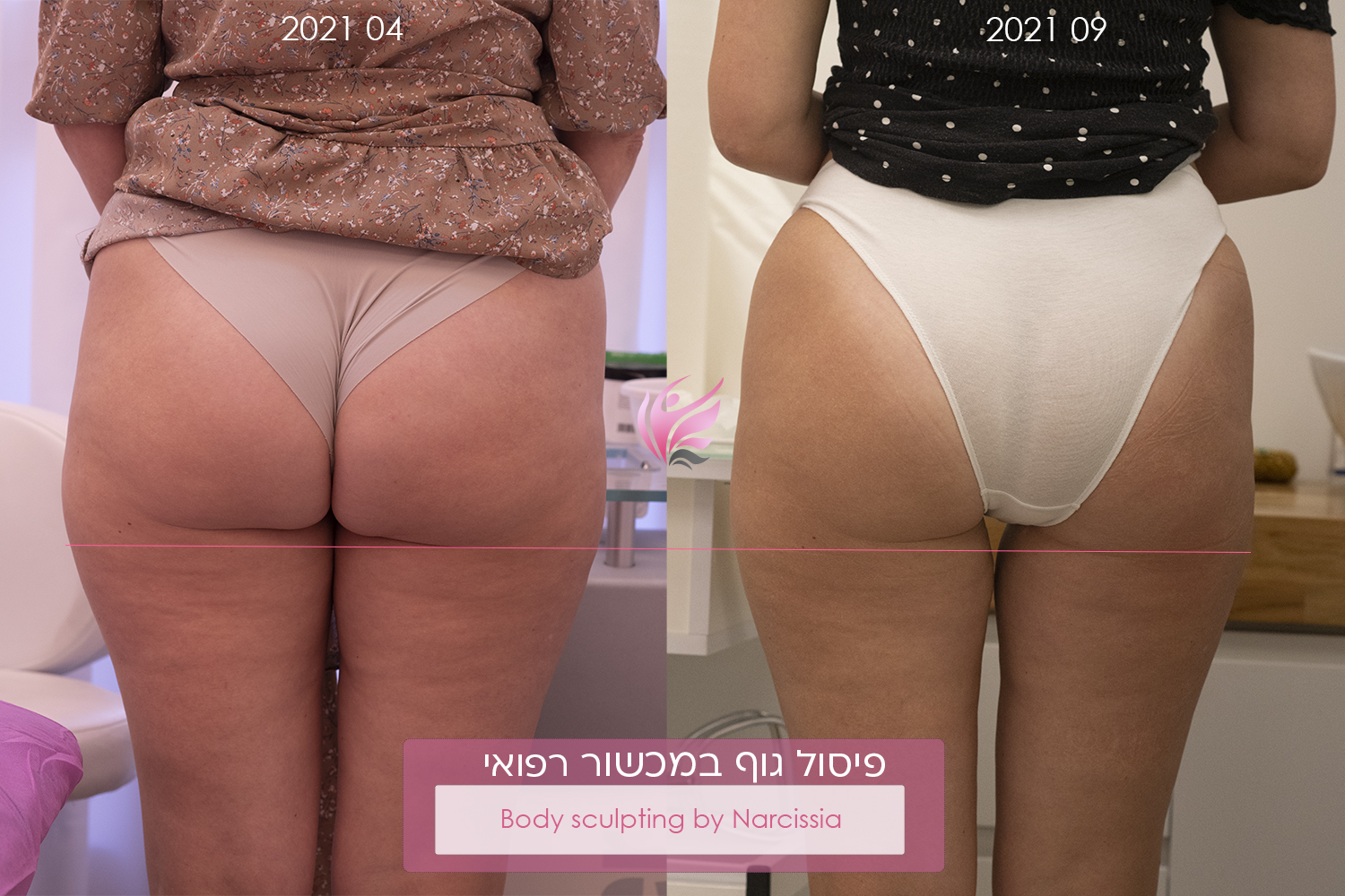 הרמת תוסיק | עיצוב ישבן | בטכנולוגיה רב עומקית מהשריר עד שכבת עור העליונה 1 מתיחת ישבן ווקטורי