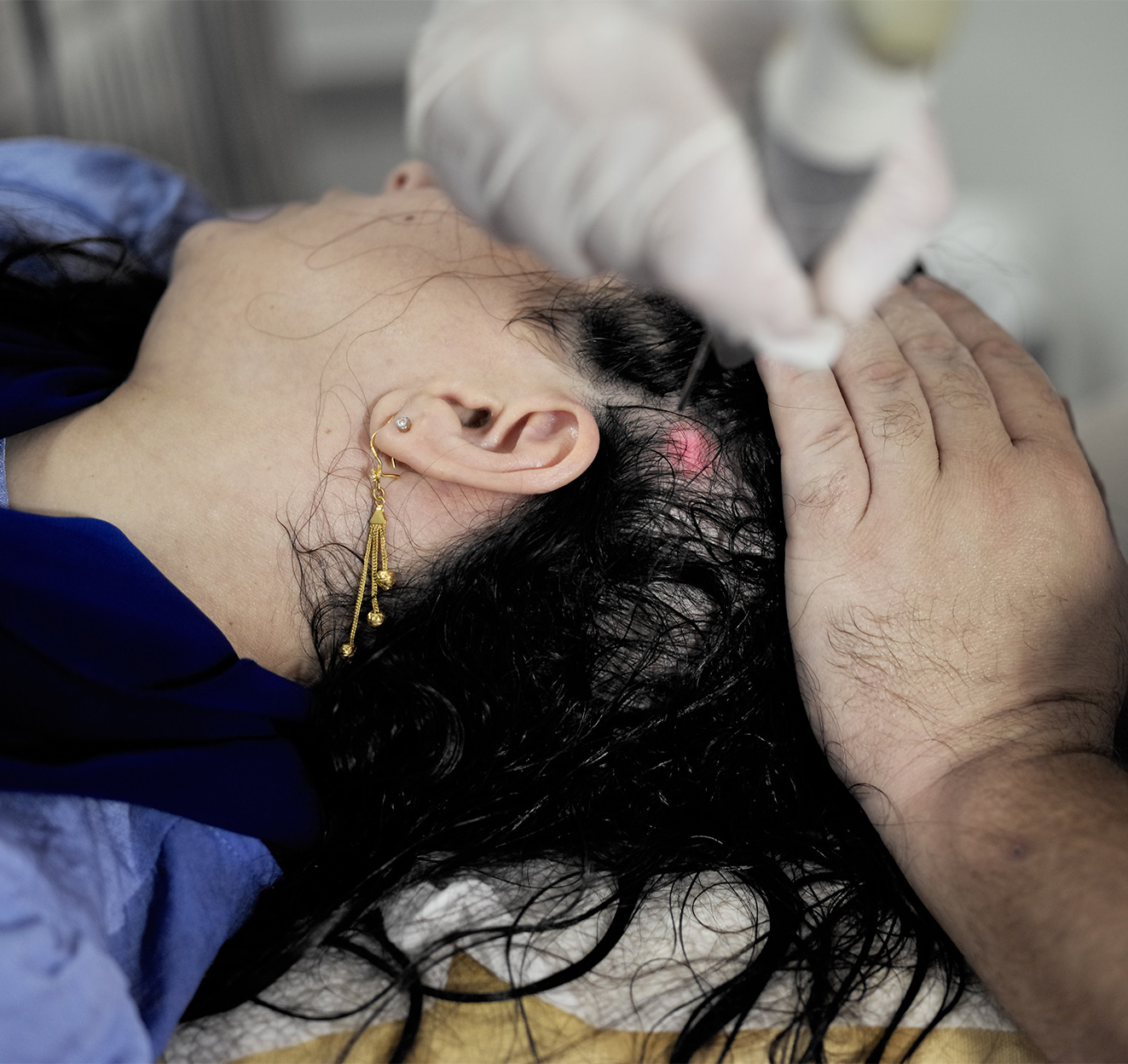 הגברת צפיפות השיער | שיפור איכות השיער | התקרחות ונשירת שיער | Alopecia 3 HaiRestart Fotona Israel