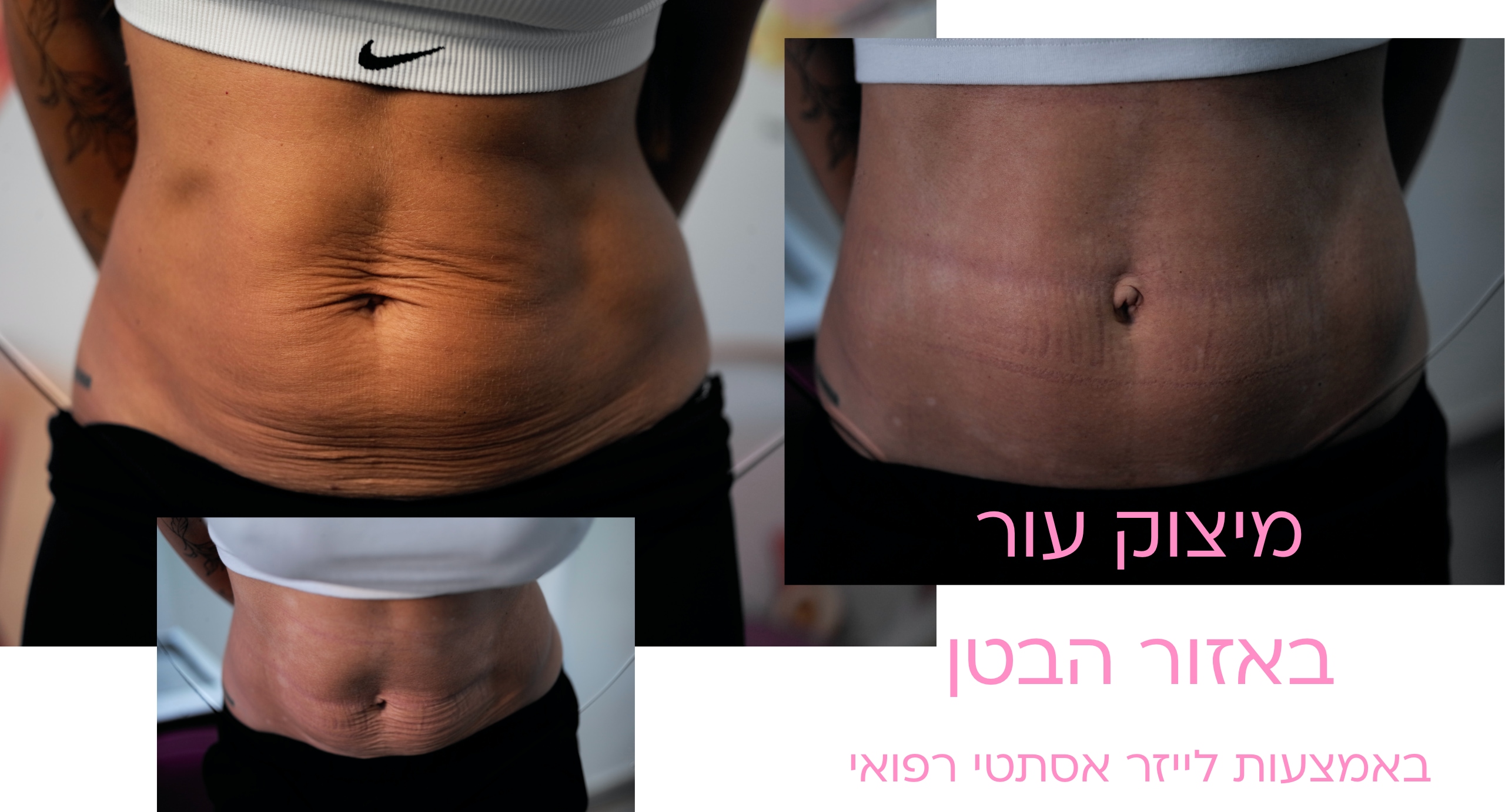 בטן 4 skin tightening on abdomen