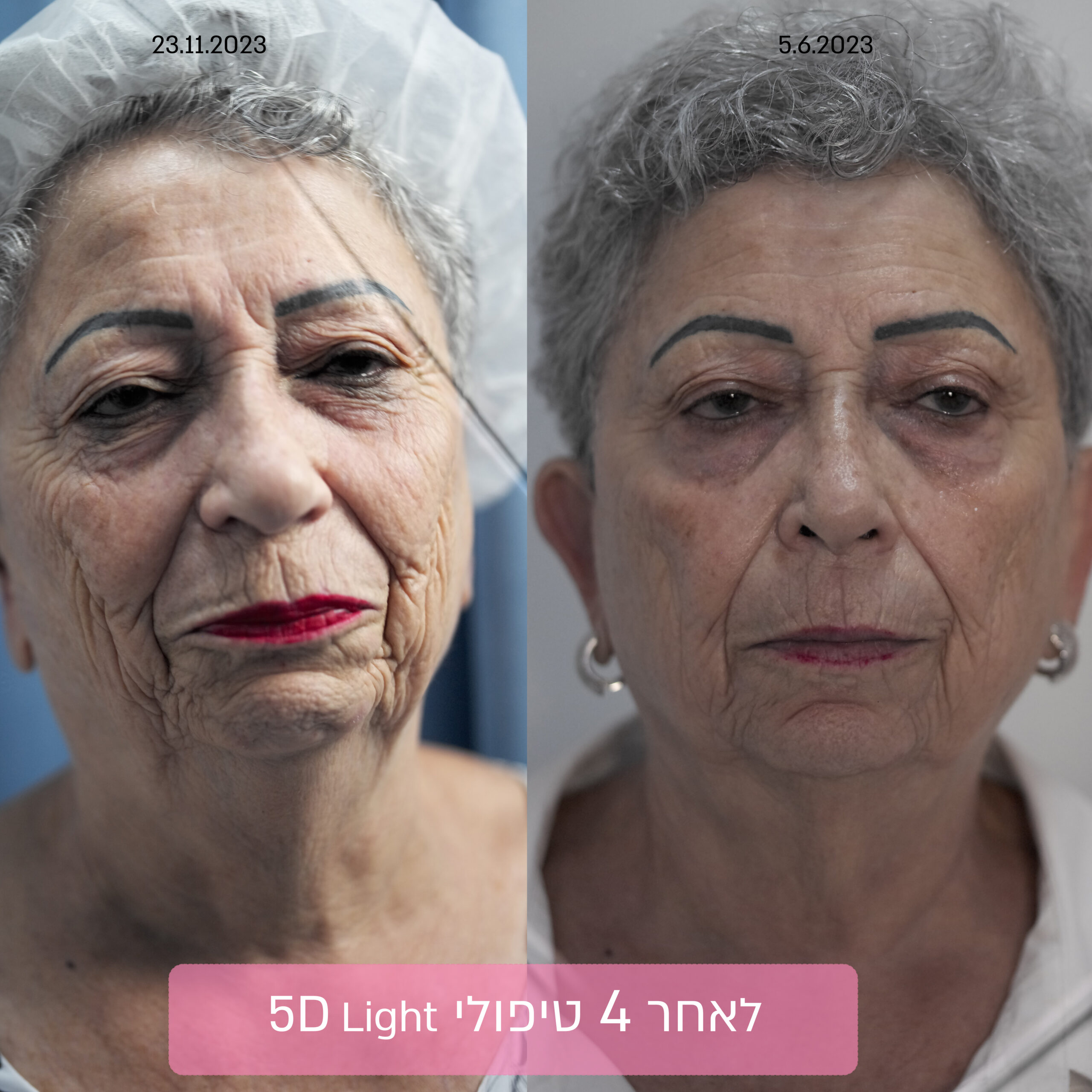 5D - пластическая лазерная медицина лица 24 תוצאה של טיפול פנים 5D לגמלאים