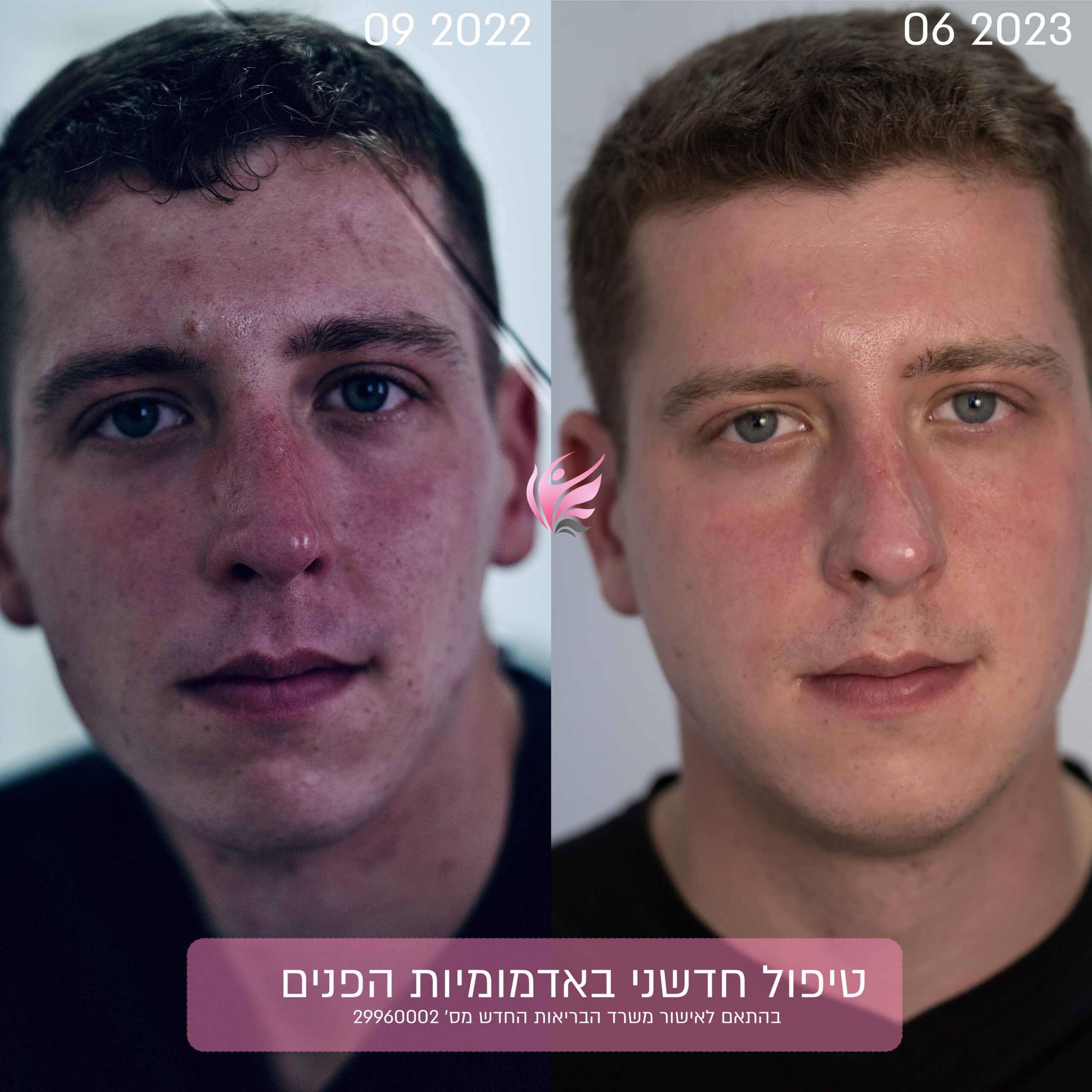 העלמת נימים מאזור הפנים | לא מסירים! 1 RhinoLase Aesthetic skin result