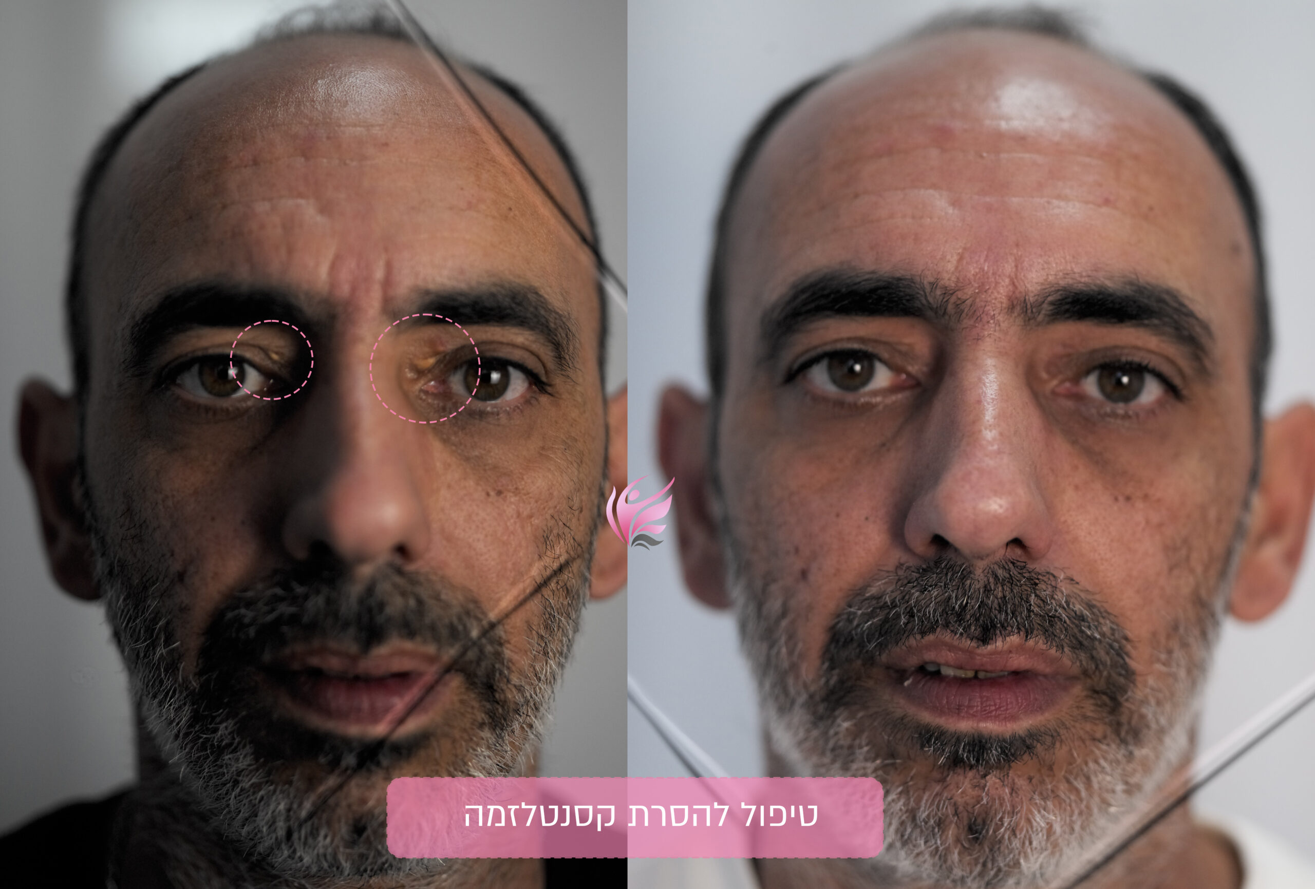טיפול בקסנטלזמה