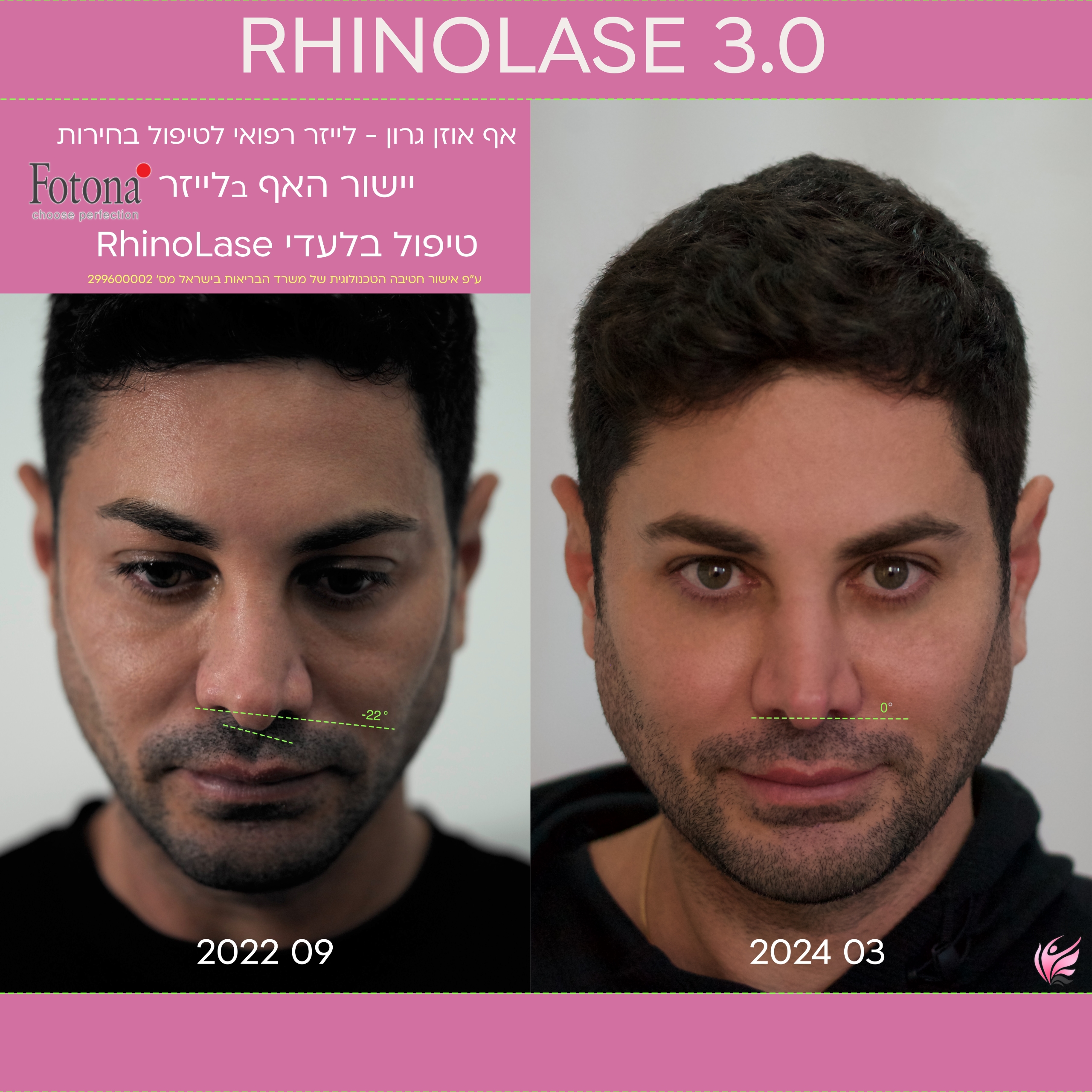 RhinoLase 2024 Narcissia