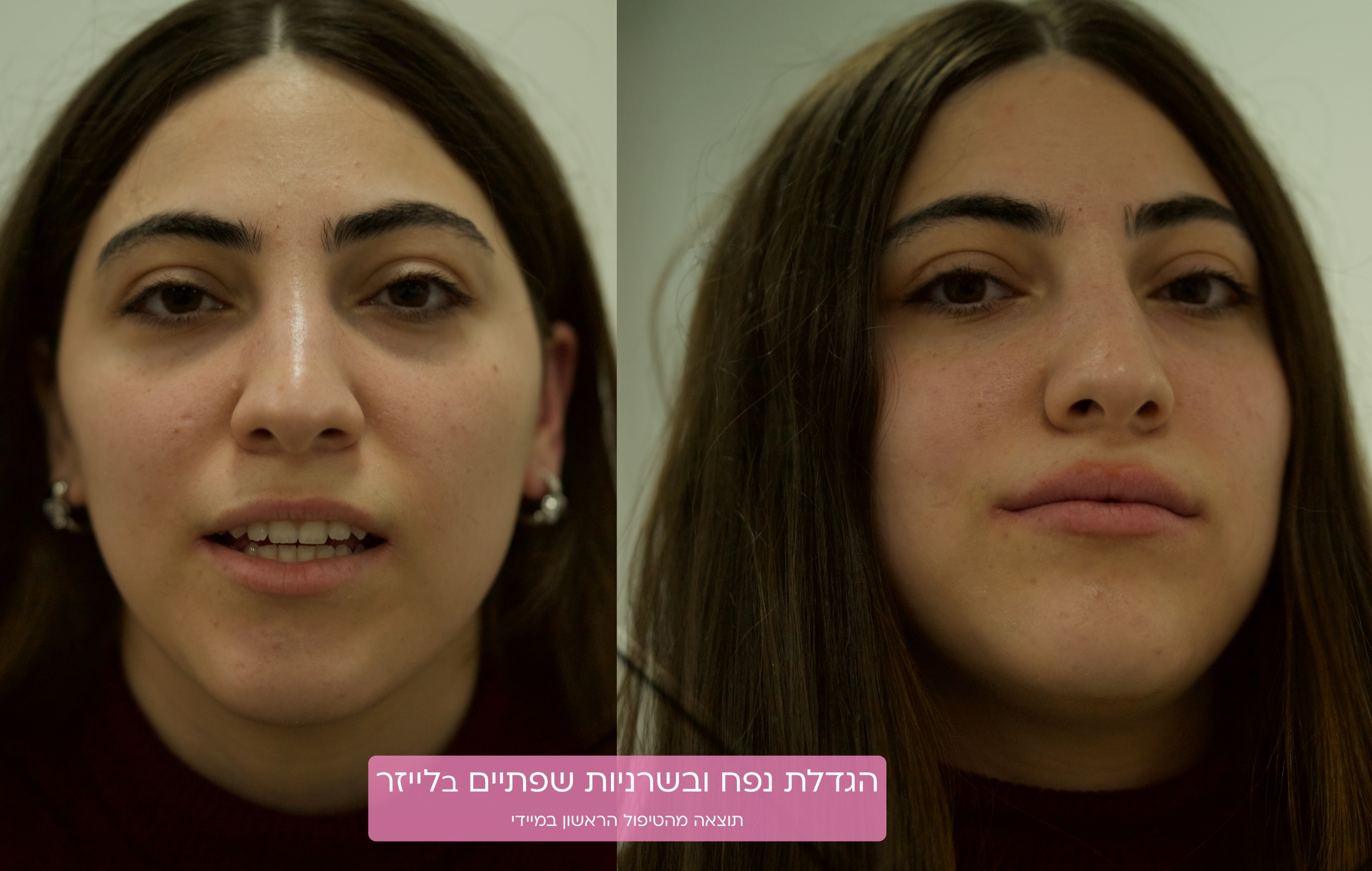 5D - מידע מקצועי 18 SmoothLips