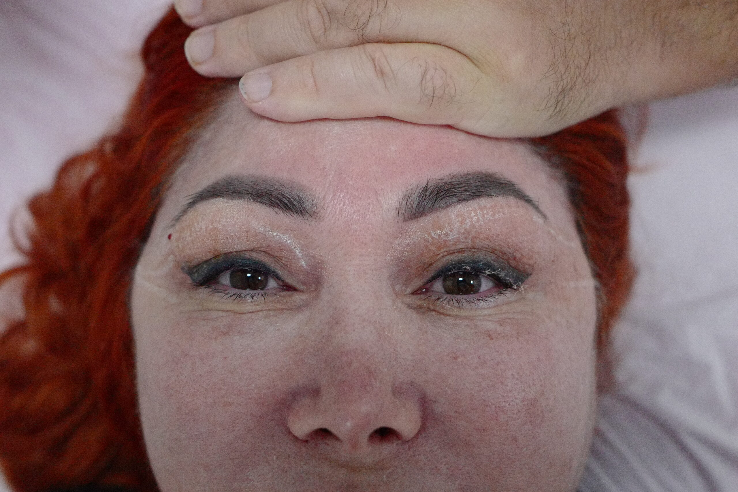 טיפול בפלזמה או בלייזר רפואי לעפעף העליון? 😁 1 skin tightening with f22