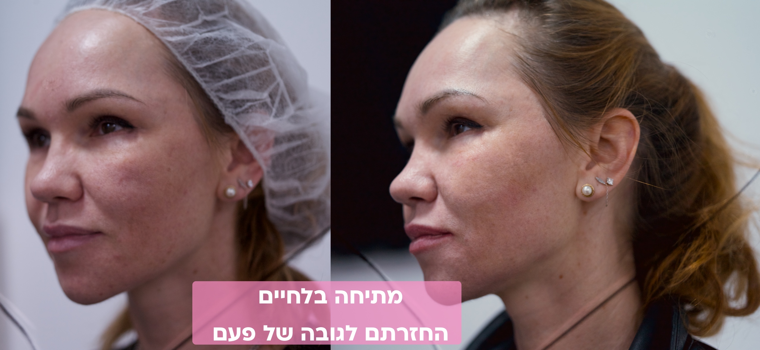 מתיחת תפוחי לחיים