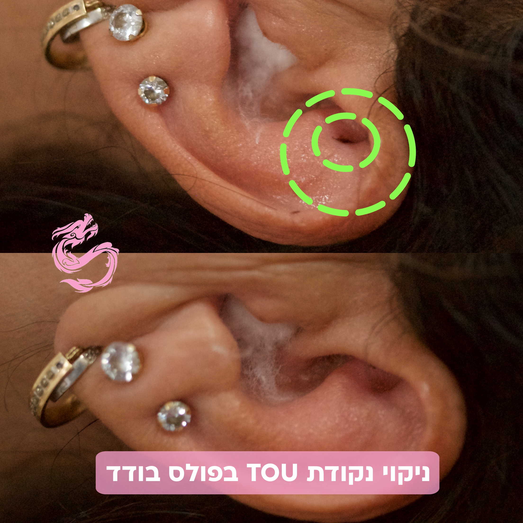‎⁨ניקוי נקודת טואו ואואו⁩