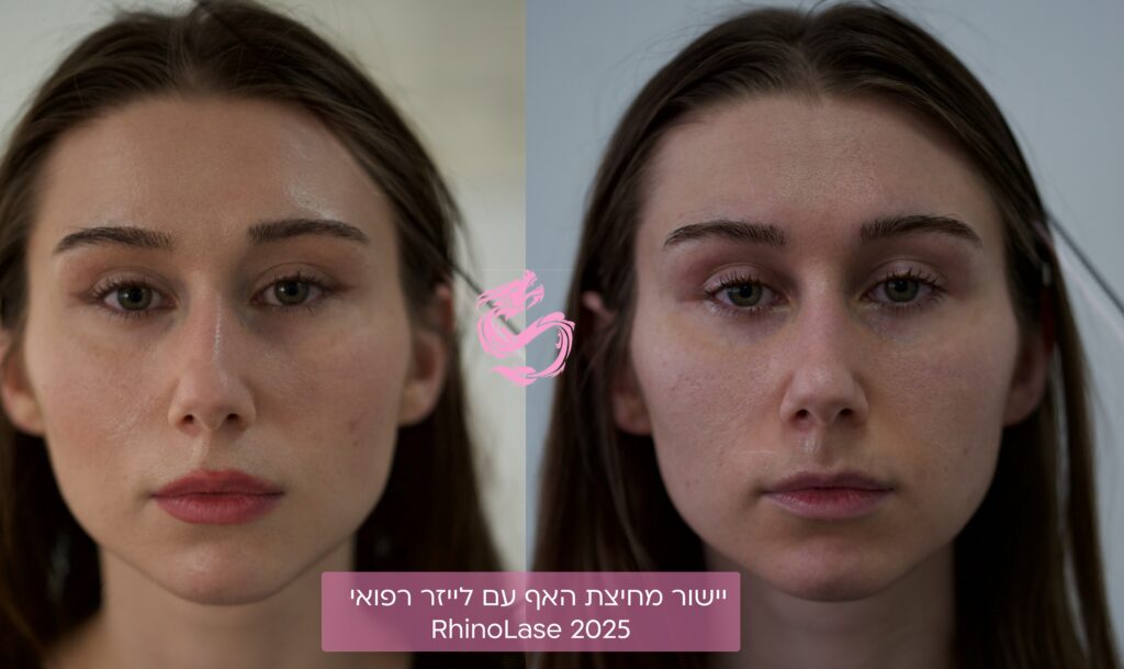 יישור מחיצת האף עם לייזר וחובת ניתוח כירורגי 2 יישור מחיצת האף