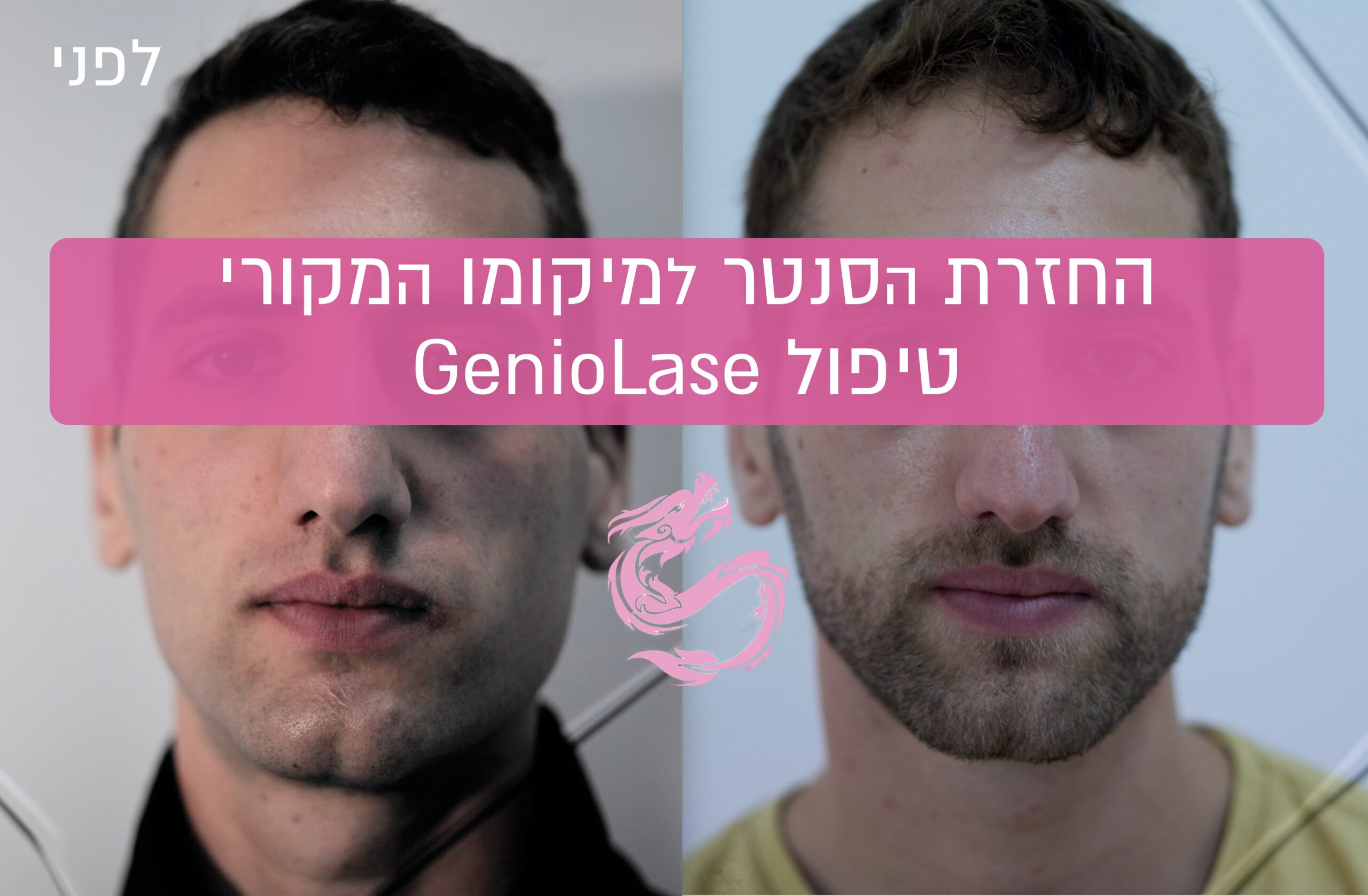 יישור סנטר בלי כירורגיה | חלופה חדשנית באמצעות לייזר רפואי 1 IMG 0603 scaled