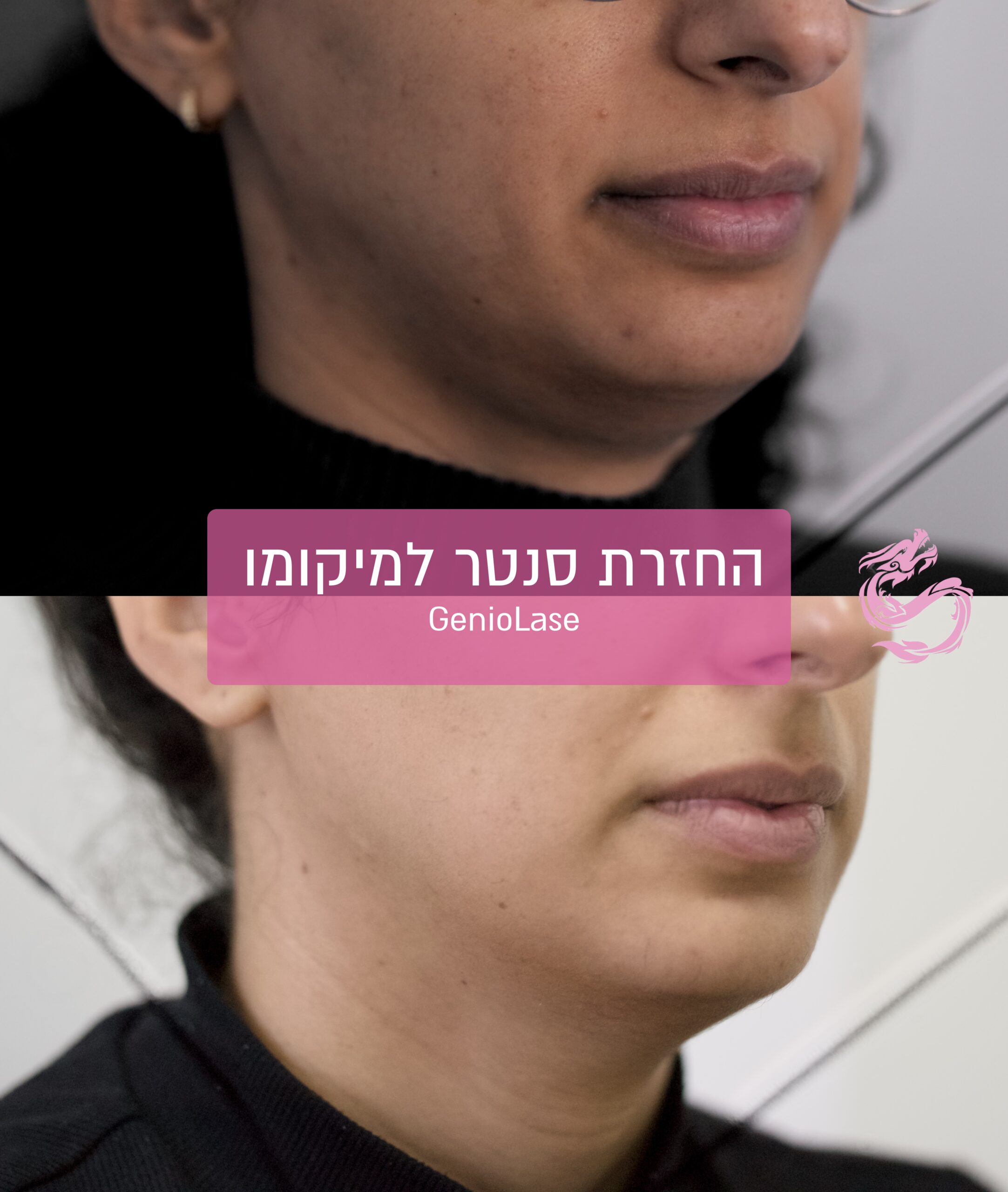 יישור סנטר בלי כירורגיה | חלופה חדשנית באמצעות לייזר רפואי 2 IMG 0606 scaled