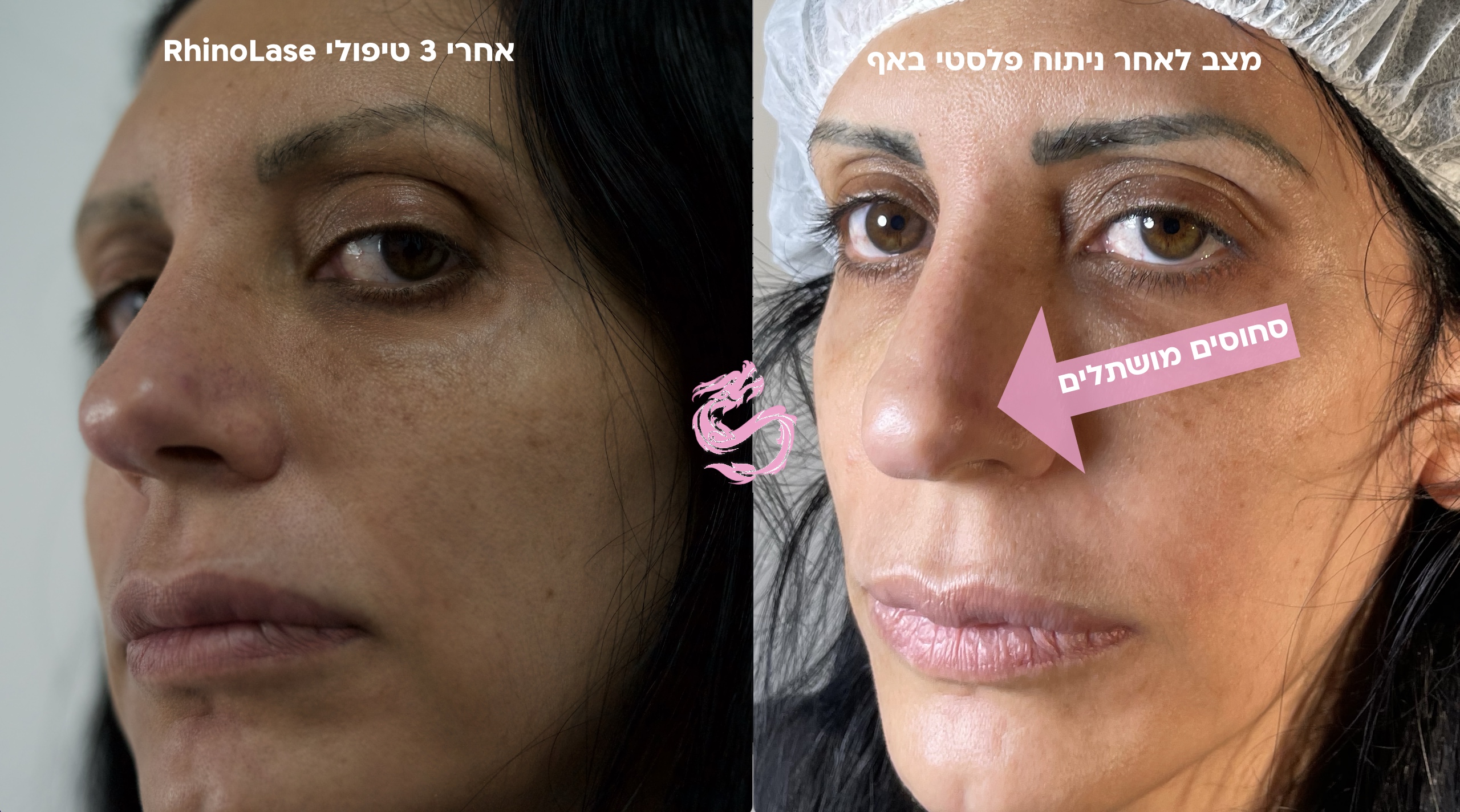 לפני ואחרי שיקום אף בלייזר